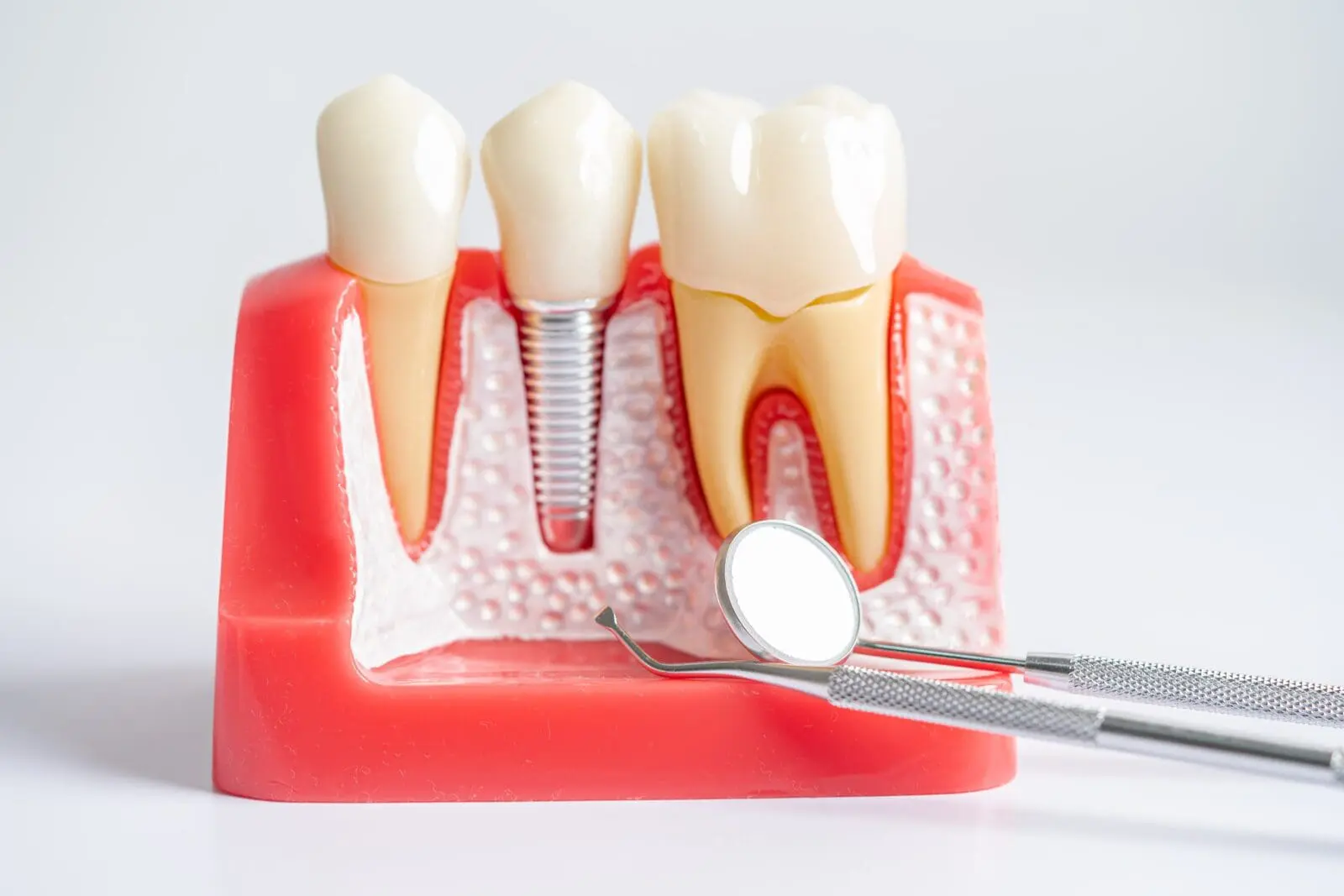 Dental implant model