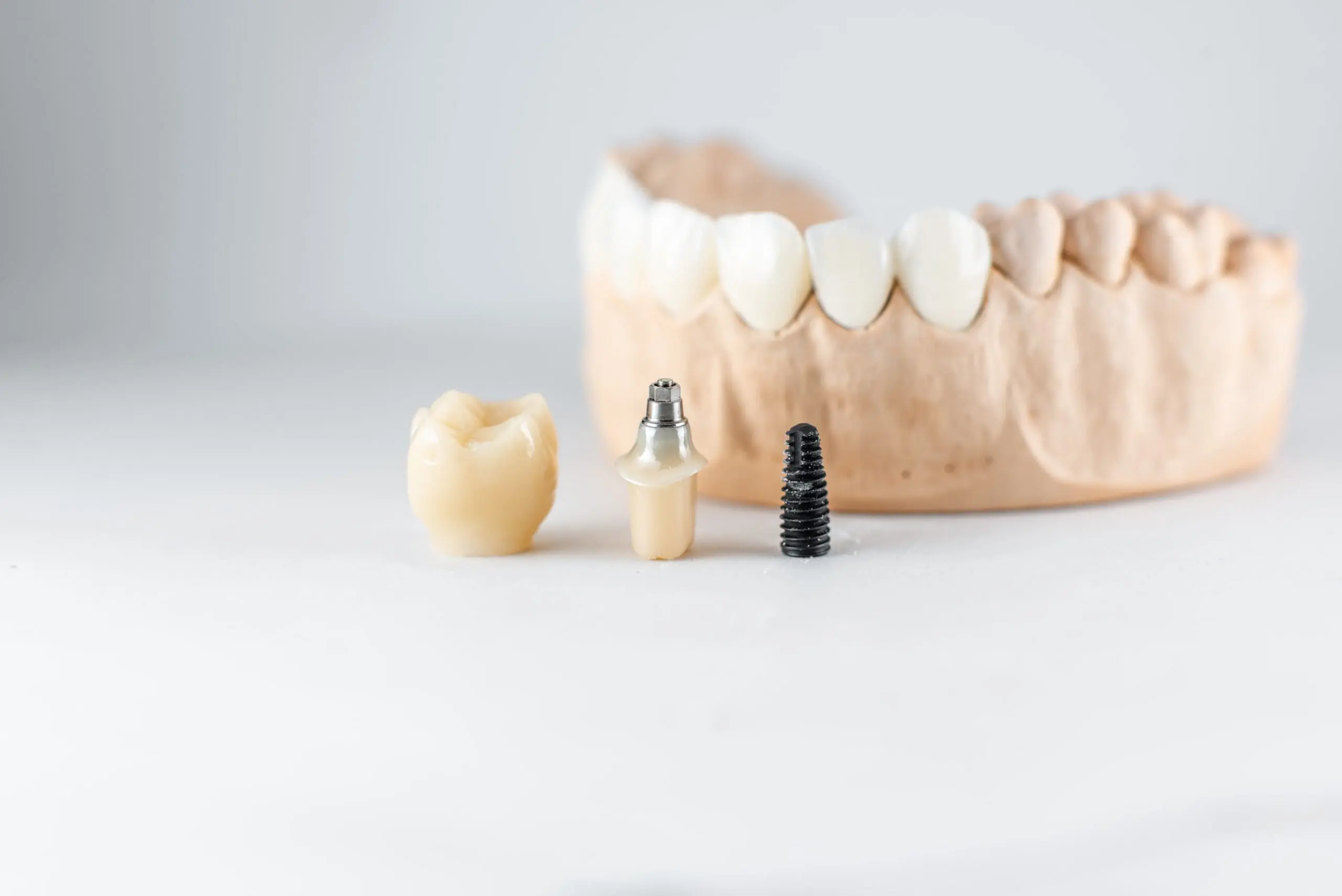 Model of artificial jaw and dental implant