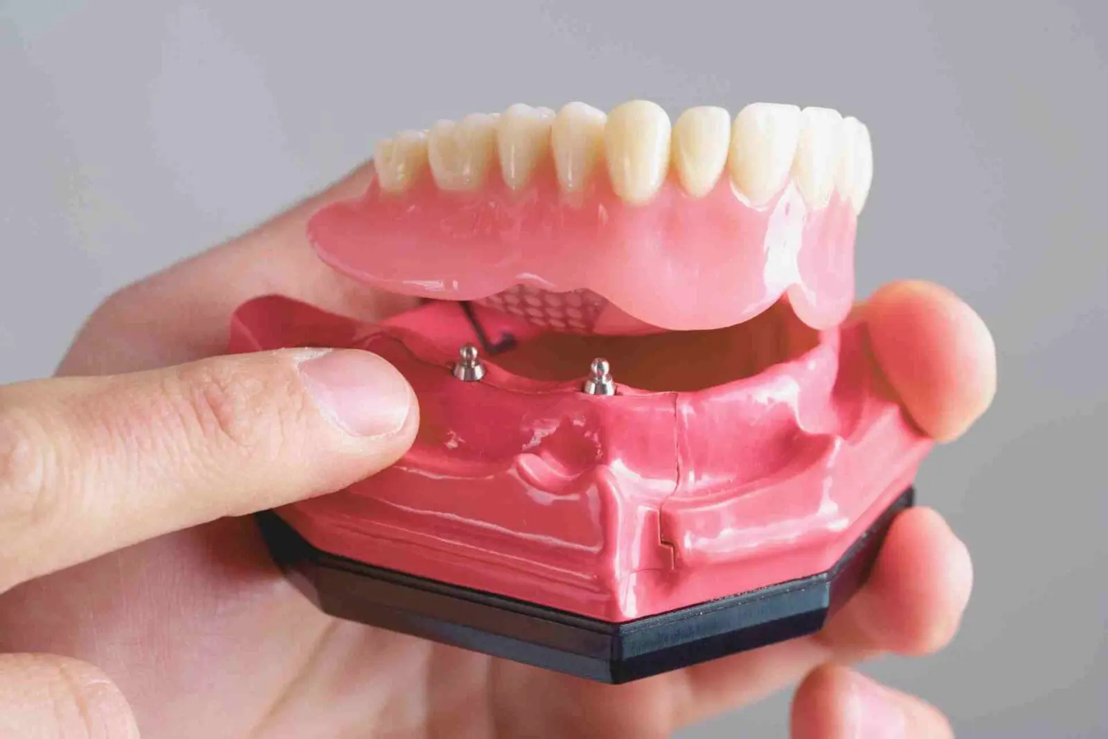All on 4 implant model.