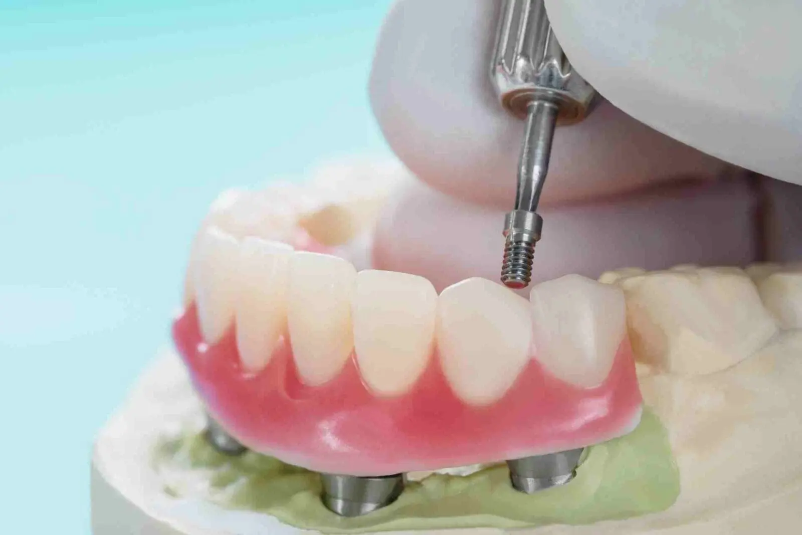 All on 4 implant model.