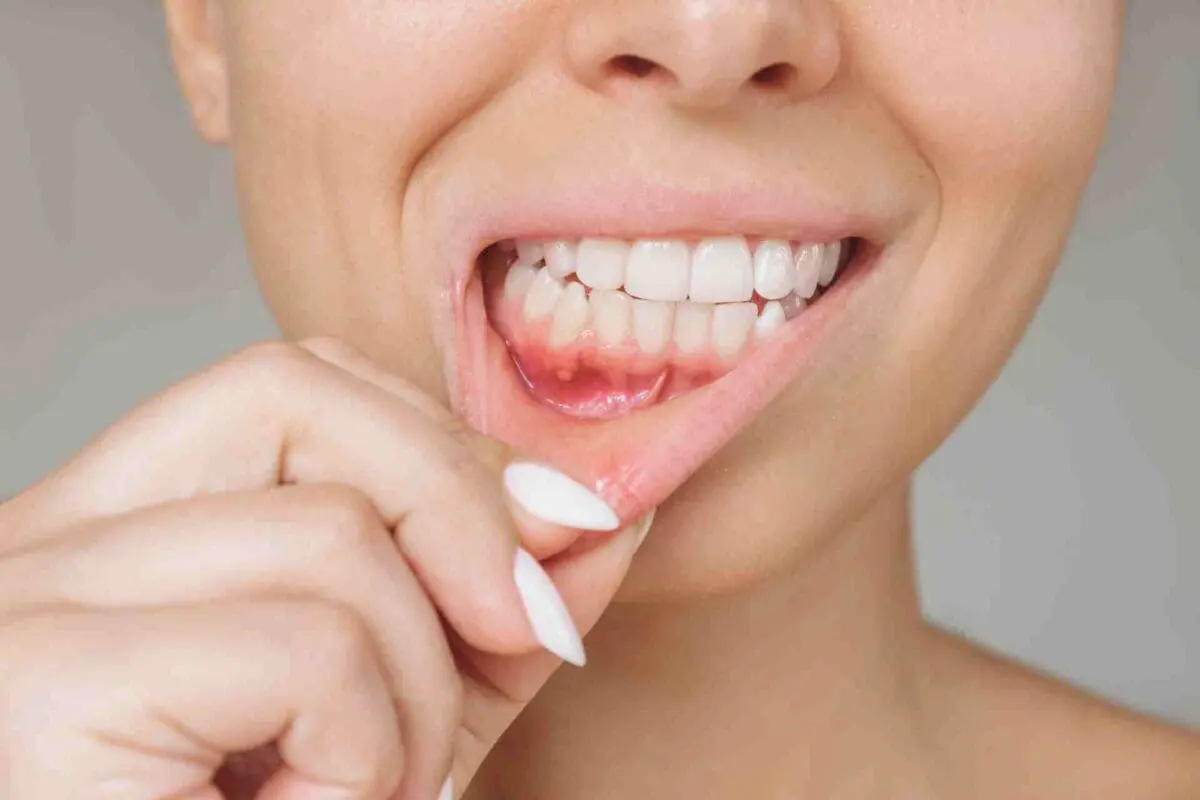 Young woman showing red gingiva with an ulcer.
