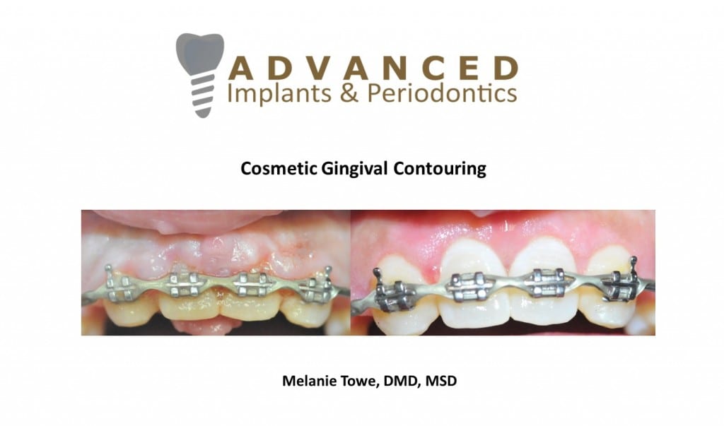 Cosmetic Gingival Contouring