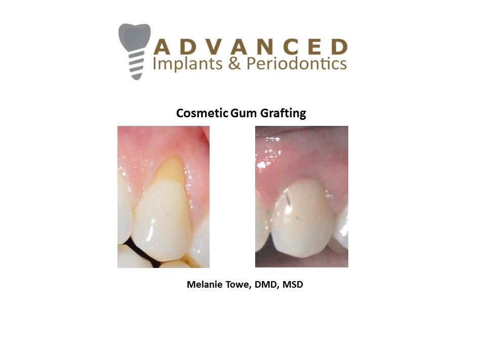 Cosmetic Gum Grafting