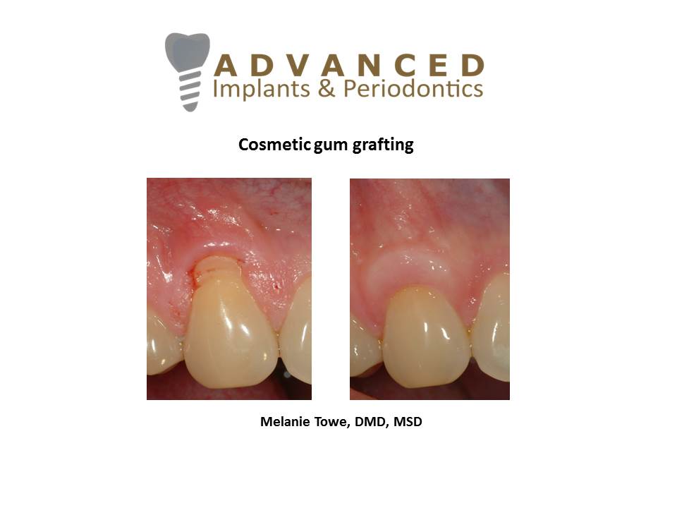 Soft tissue grafting