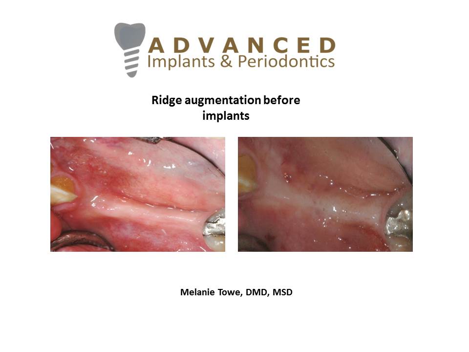 Ridge augmentation