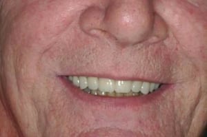 Full-Mouth-Implant-Replacement-Case-1-After-300x199