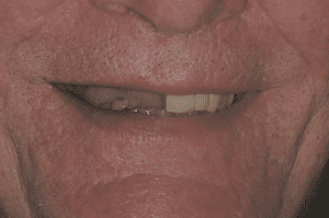 Full-Mouth-Implant-Replacement-Case-1-Before-300x199