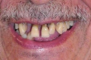 Full-Mouth-Implant-Replacement-Case-2-Before-300x199