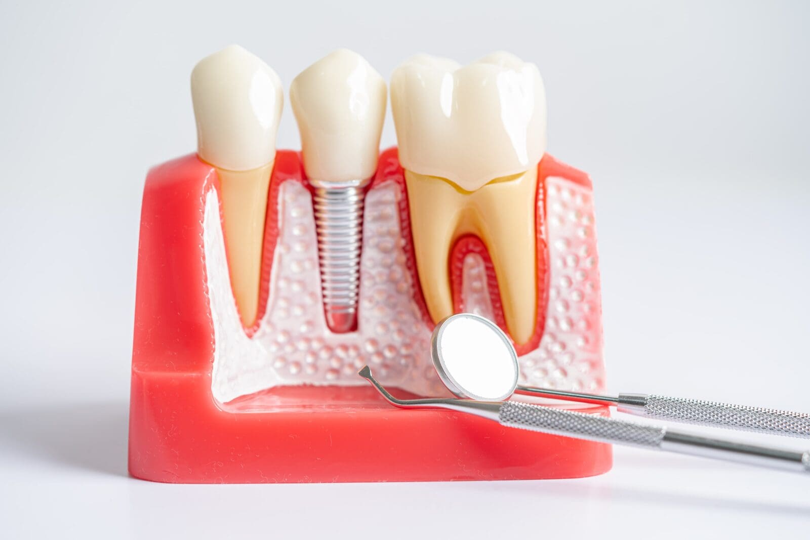 Dental implant model