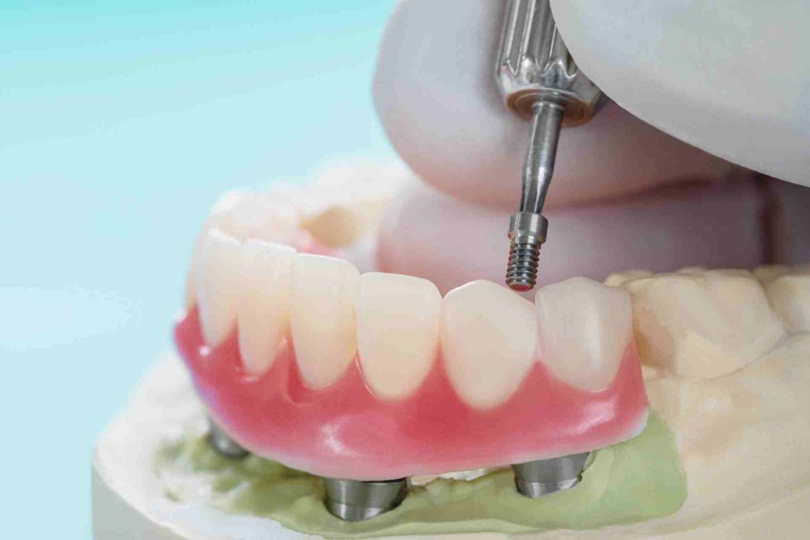 All on 4 implant model.