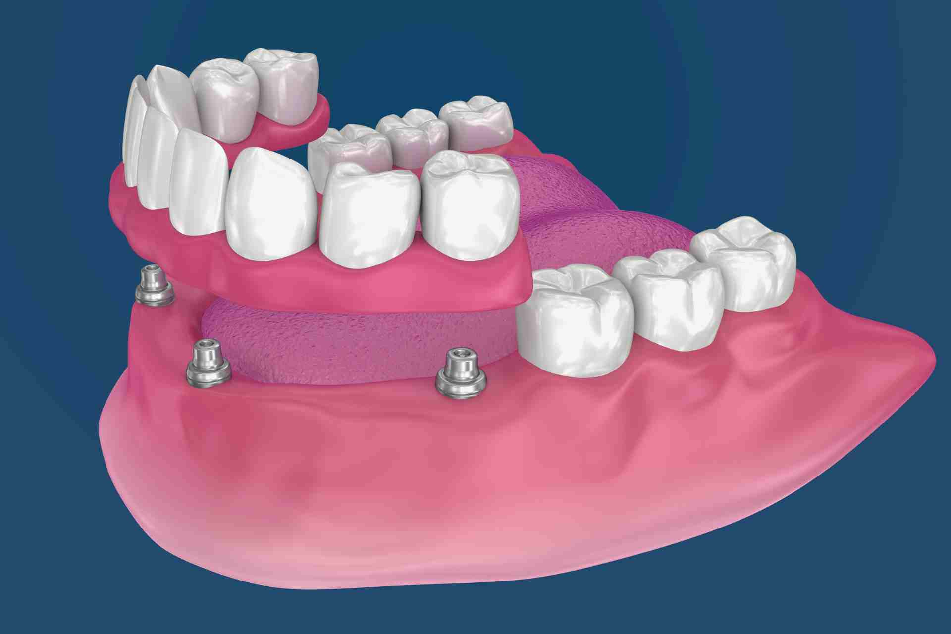 All on 4 implant model