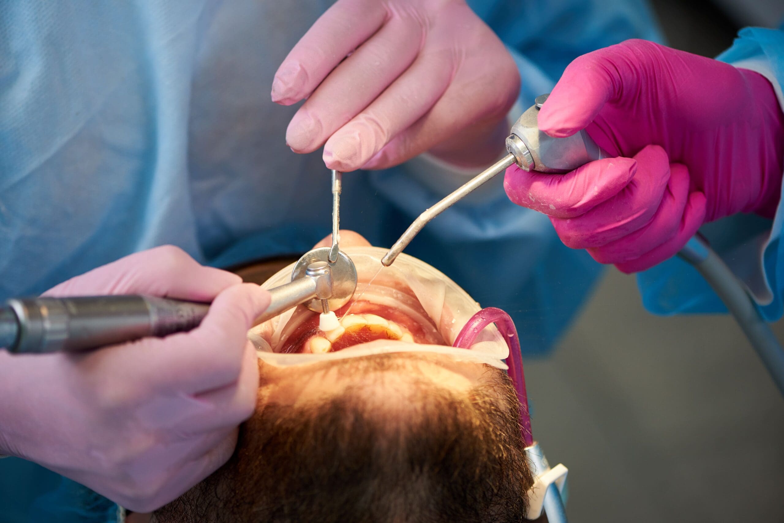 Closeup of a scaling and polishing procedure performed by two dentists.