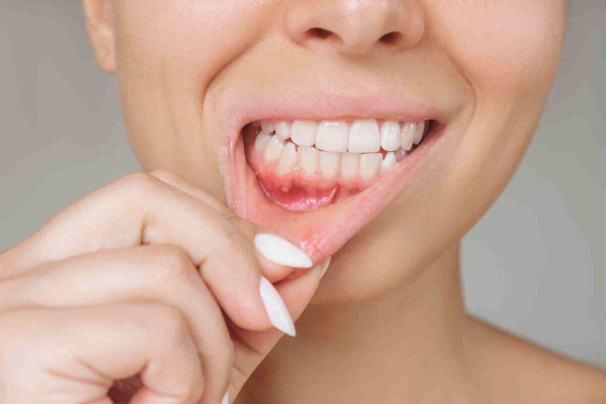 Young woman showing red gingiva with an ulcer.